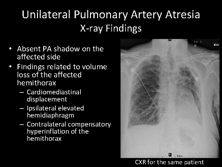 Unilateral Pulmonary Artery Atresia X-ray Findings • Absent PA shadow on the affected side