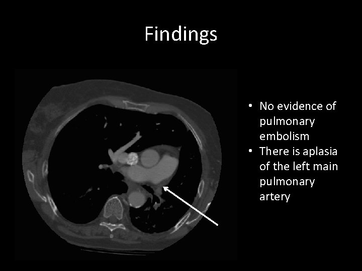 Findings • No evidence of pulmonary embolism • There is aplasia of the left