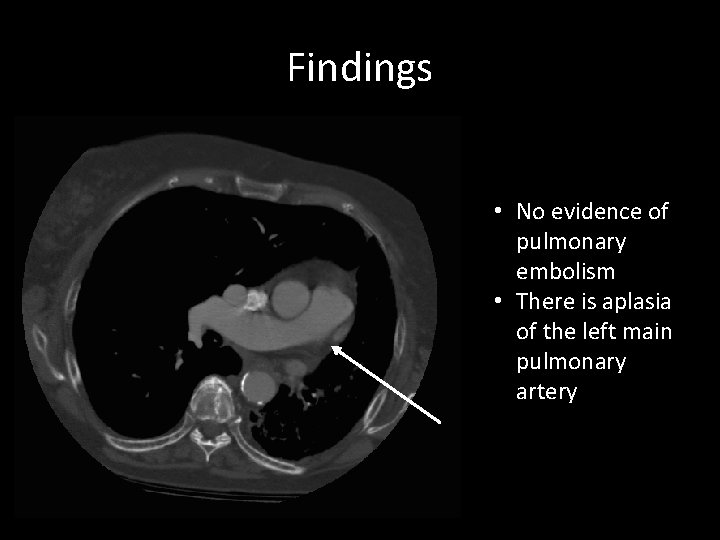 Findings • No evidence of pulmonary embolism • There is aplasia of the left