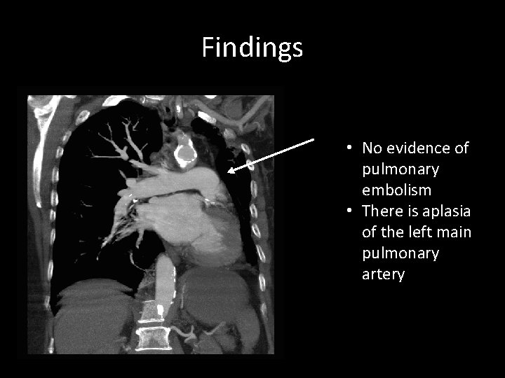 Findings • No evidence of pulmonary embolism • There is aplasia of the left