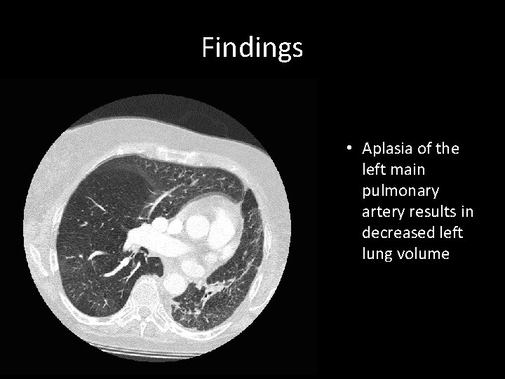 Findings • Aplasia of the left main pulmonary artery results in decreased left lung