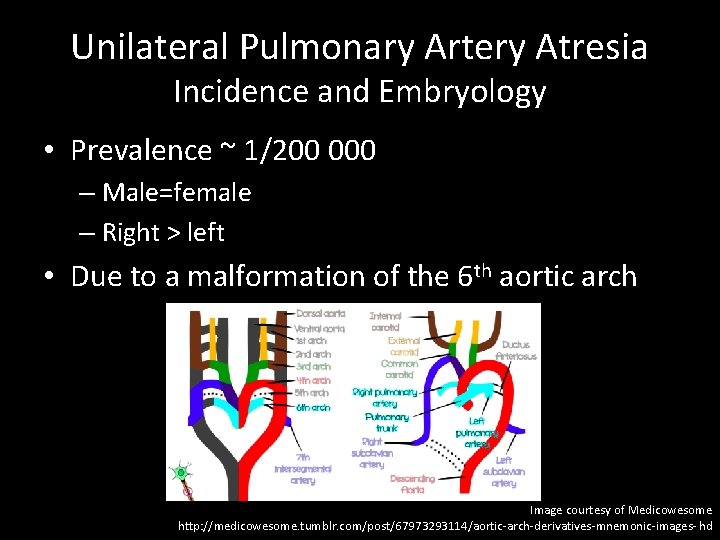 Unilateral Pulmonary Artery Atresia Incidence and Embryology • Prevalence ~ 1/200 000 – Male=female