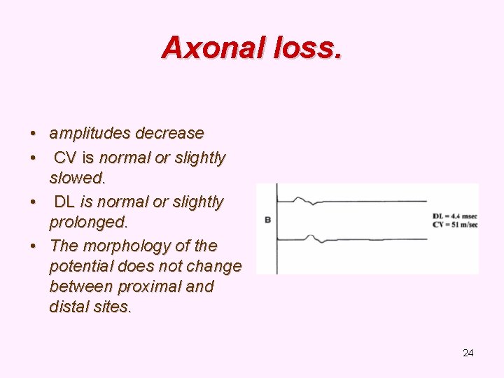 Axonal loss. • amplitudes decrease • CV is normal or slightly slowed. • DL