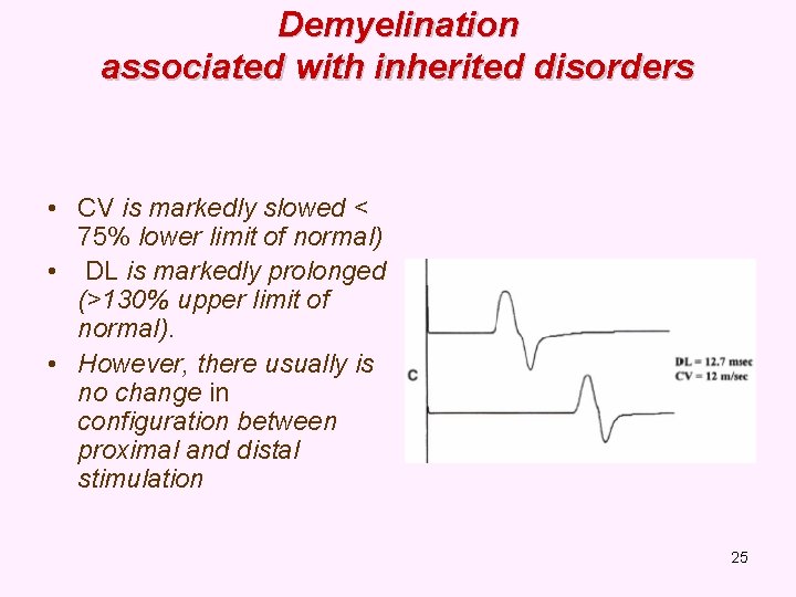 Demyelination associated with inherited disorders • CV is markedly slowed < 75% lower limit