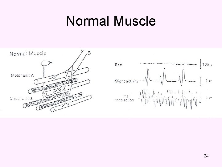 Normal Muscle 34 