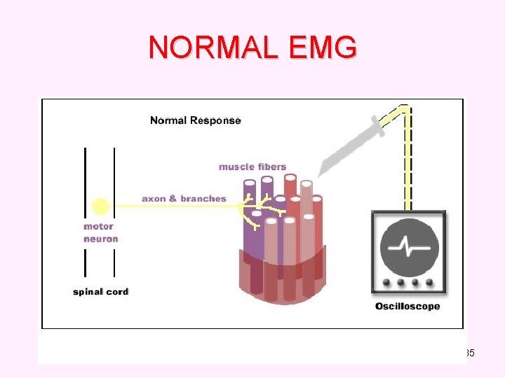 NORMAL EMG 35 