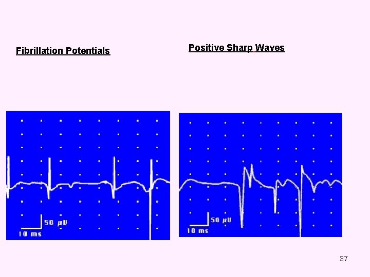 Fibrillation Potentials Positive Sharp Waves 37 