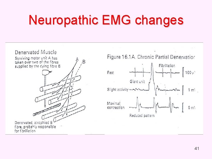 Neuropathic EMG changes 41 