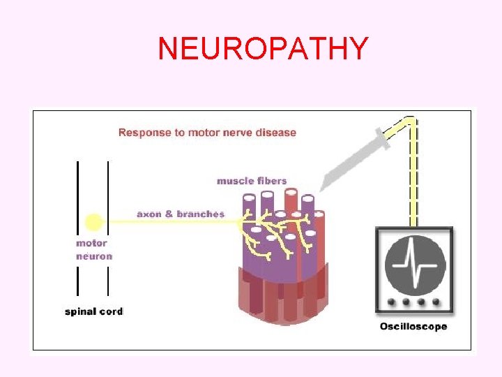 NEUROPATHY 42 