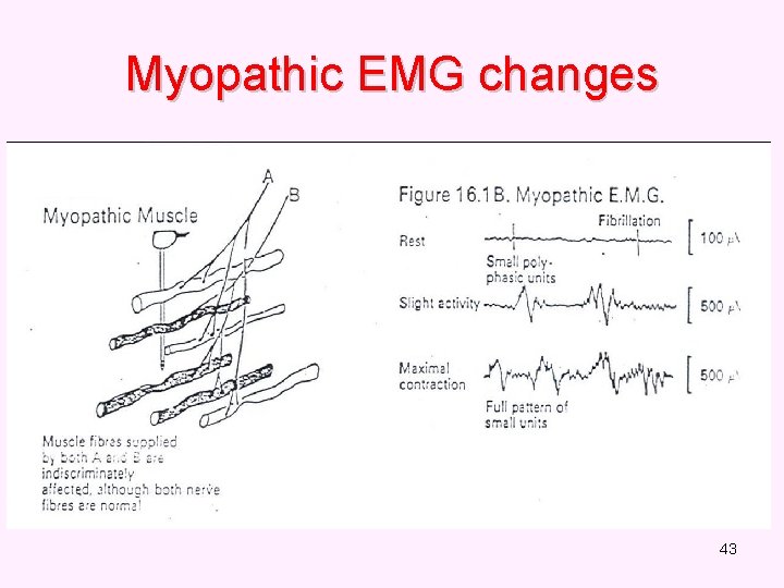 Myopathic EMG changes 43 