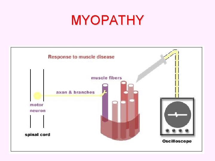 MYOPATHY 44 