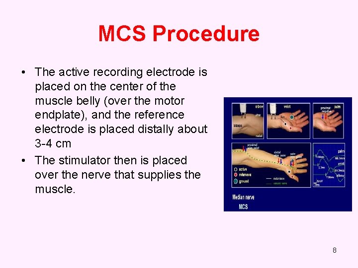 MCS Procedure • The active recording electrode is placed on the center of the