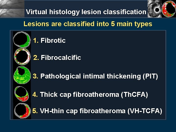 Virtual histology lesion classification Lesions are classified into 5 main types 1. Fibrotic 2.