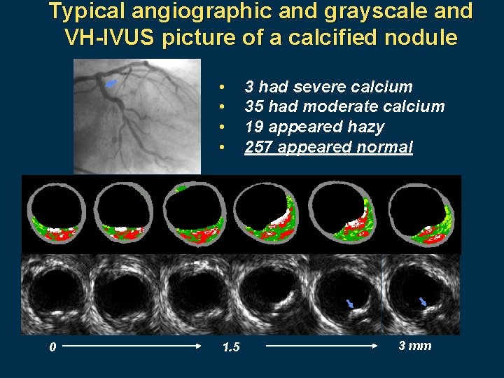 Typical angiographic and grayscale and VH-IVUS picture of a calcified nodule • • 0