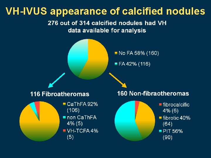 VH-IVUS appearance of calcified nodules 