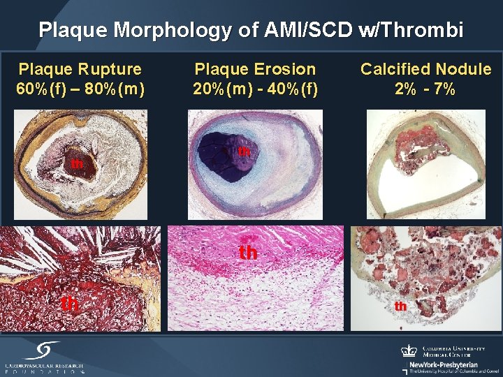 Plaque Morphology of AMI/SCD w/Thrombi Plaque Rupture 60%(f) – 80%(m) th Plaque Erosion 20%(m)