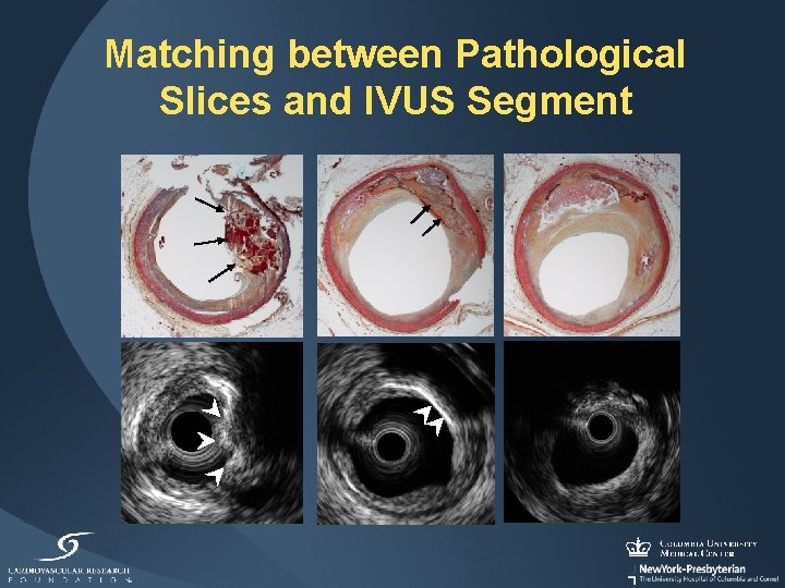 Matching between Pathological Slices and IVUS Segment 