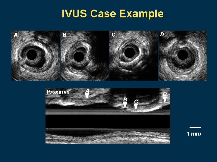 IVUS Case Example A B Proximal D C A B D C 1 mm
