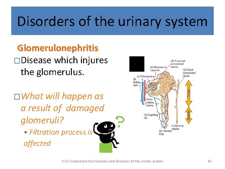 Disorders of the urinary system Glomerulonephritis �Disease which injures the glomerulus. �What will happen