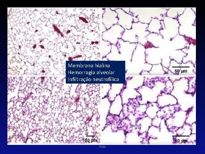 Membrana hialina Hemorragia alveolar Infiltração neutrofílica PVM 