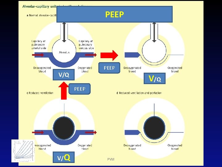 PEEP V/Q PVM 