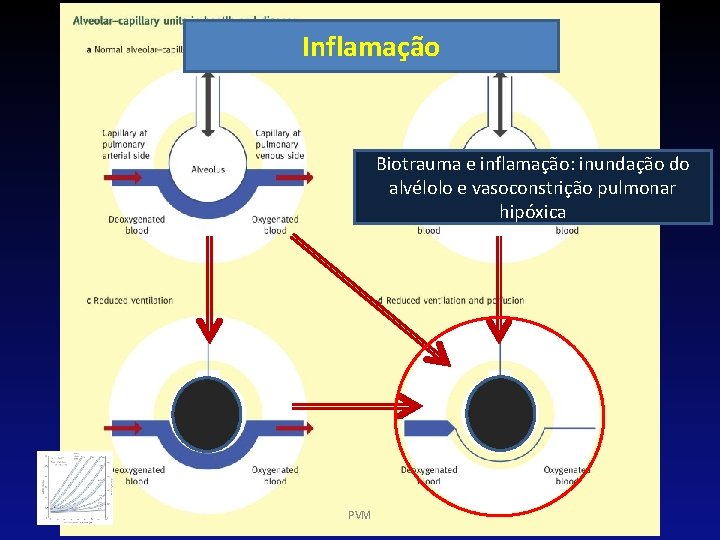 Inflamação Biotrauma e inflamação: inundação do alvélolo e vasoconstrição pulmonar hipóxica PVM 