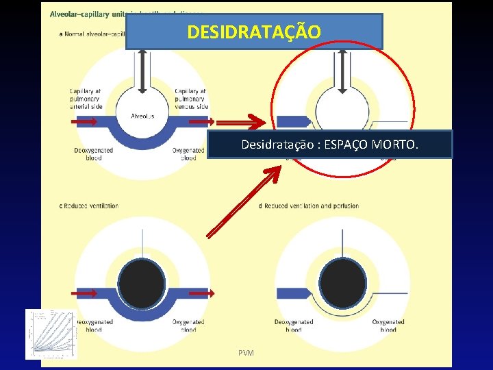 DESIDRATAÇÃO Desidratação : ESPAÇO MORTO. PVM 