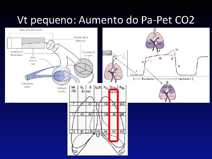 Vt pequeno: Aumento do Pa-Pet CO 2 PVM 