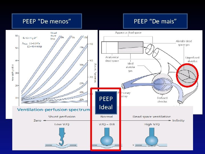 PEEP “De menos” PEEP “De mais” PEEP Ideal PVM 