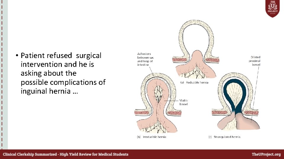  • Patient refused surgical intervention and he is asking about the possible complications