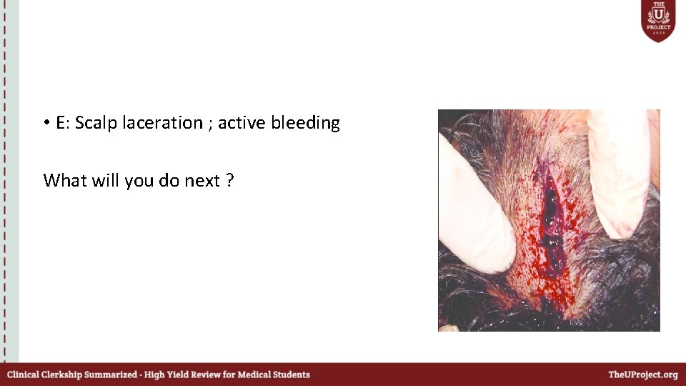  • E: Scalp laceration ; active bleeding What will you do next ?