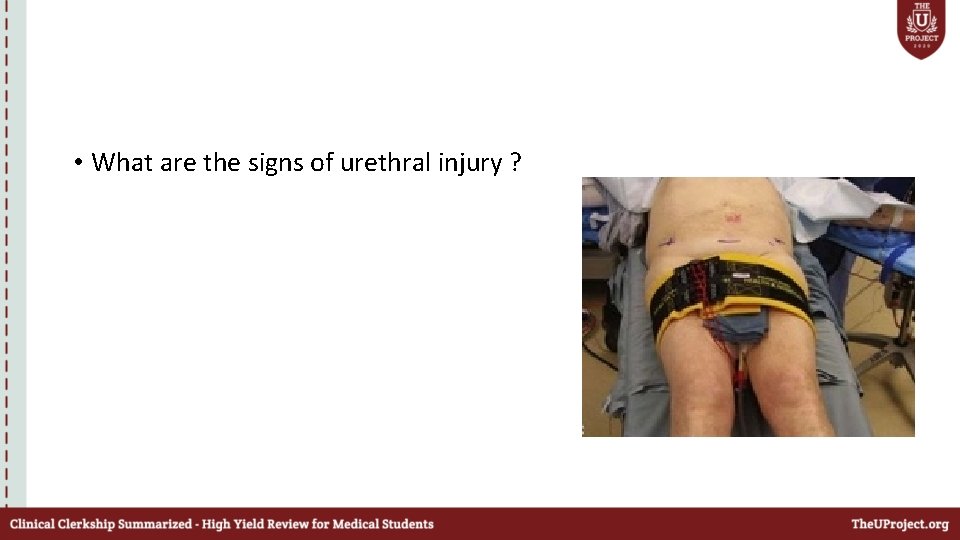  • What are the signs of urethral injury ? 