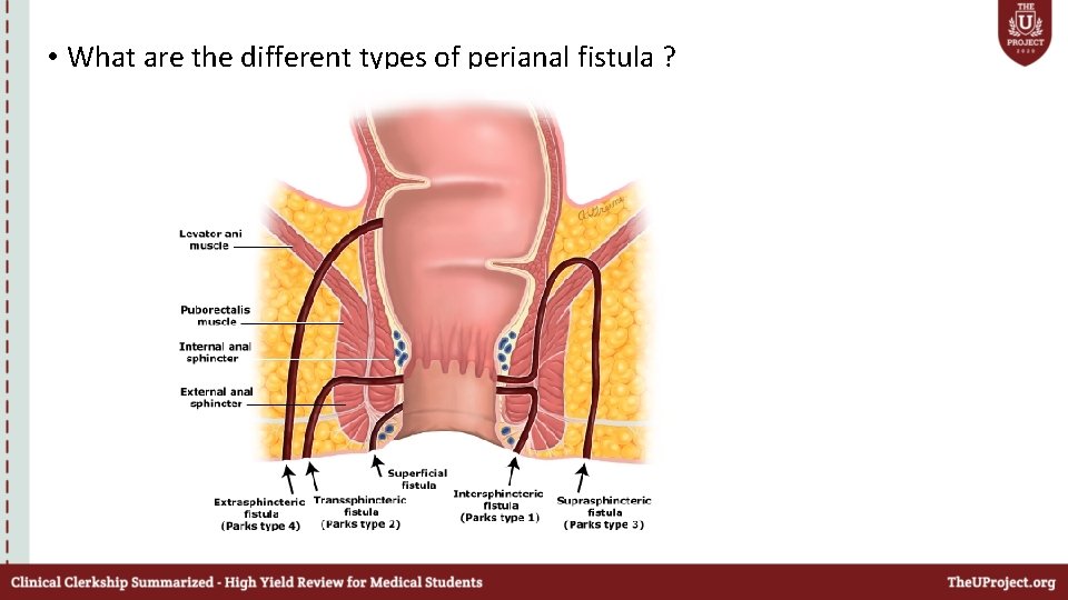  • What are the different types of perianal fistula ? 