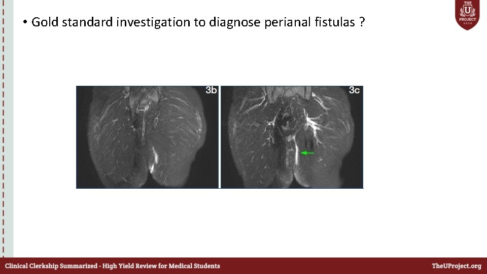  • Gold standard investigation to diagnose perianal fistulas ? 