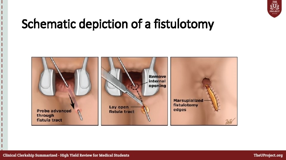 Schematic depiction of a fistulotomy 