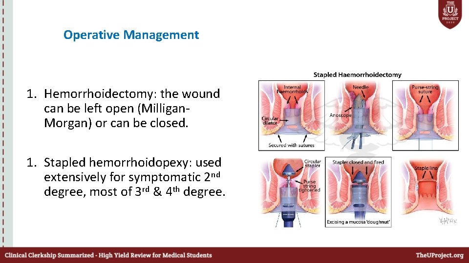 Operative Management 1. Hemorrhoidectomy: the wound can be left open (Milligan. Morgan) or can