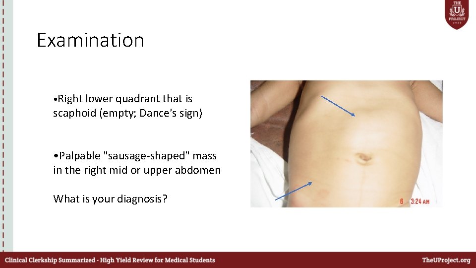 Examination • Right lower quadrant that is scaphoid (empty; Dance's sign) • Palpable "sausage-shaped"