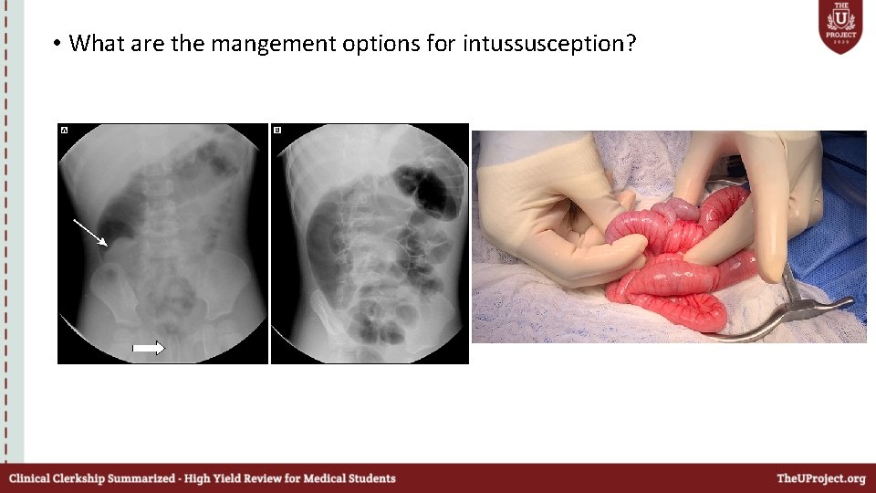  • What are the mangement options for intussusception? 