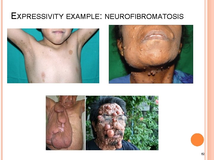 EXPRESSIVITY EXAMPLE: NEUROFIBROMATOSIS 62 
