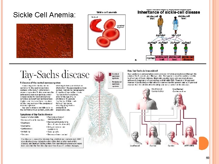 Sickle Cell Anemia: 68 
