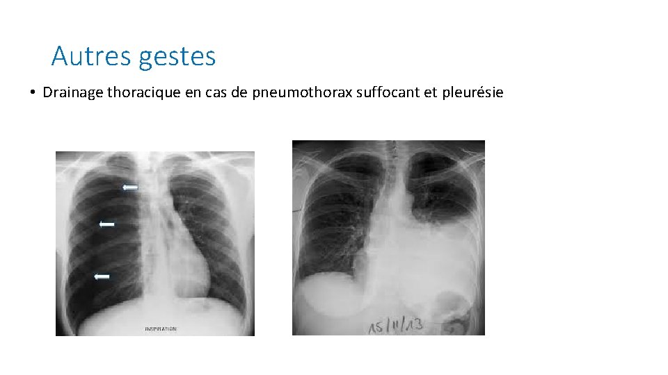 Autres gestes • Drainage thoracique en cas de pneumothorax suffocant et pleurésie Autres gestes • Drainage thoracique en cas de pneumothorax suffocant et pleurésie
