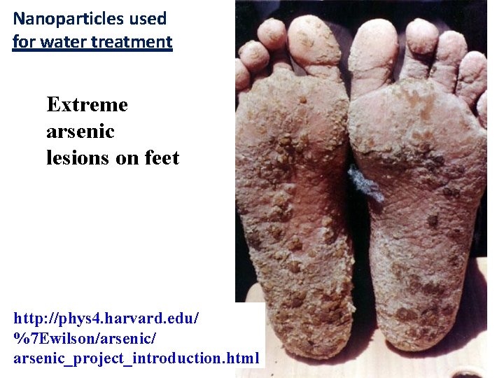 Nanoparticles used for water treatment Extreme arsenic lesions on feet http: //phys 4. harvard.