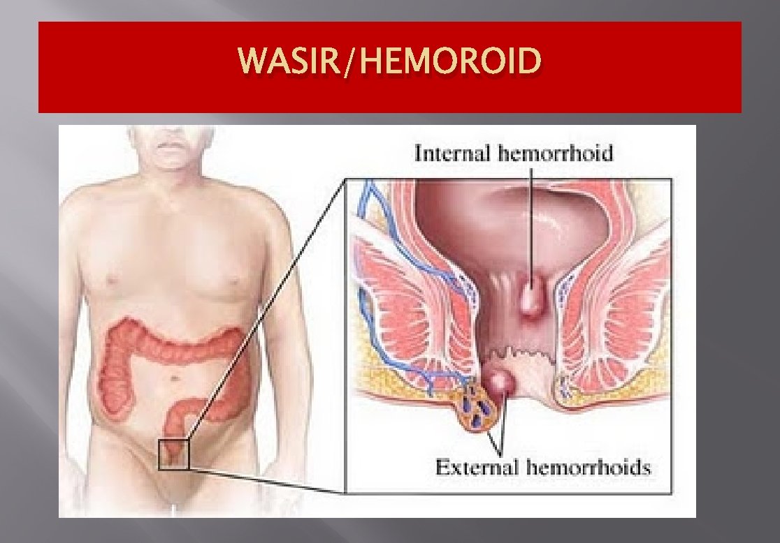WASIR/HEMOROID 