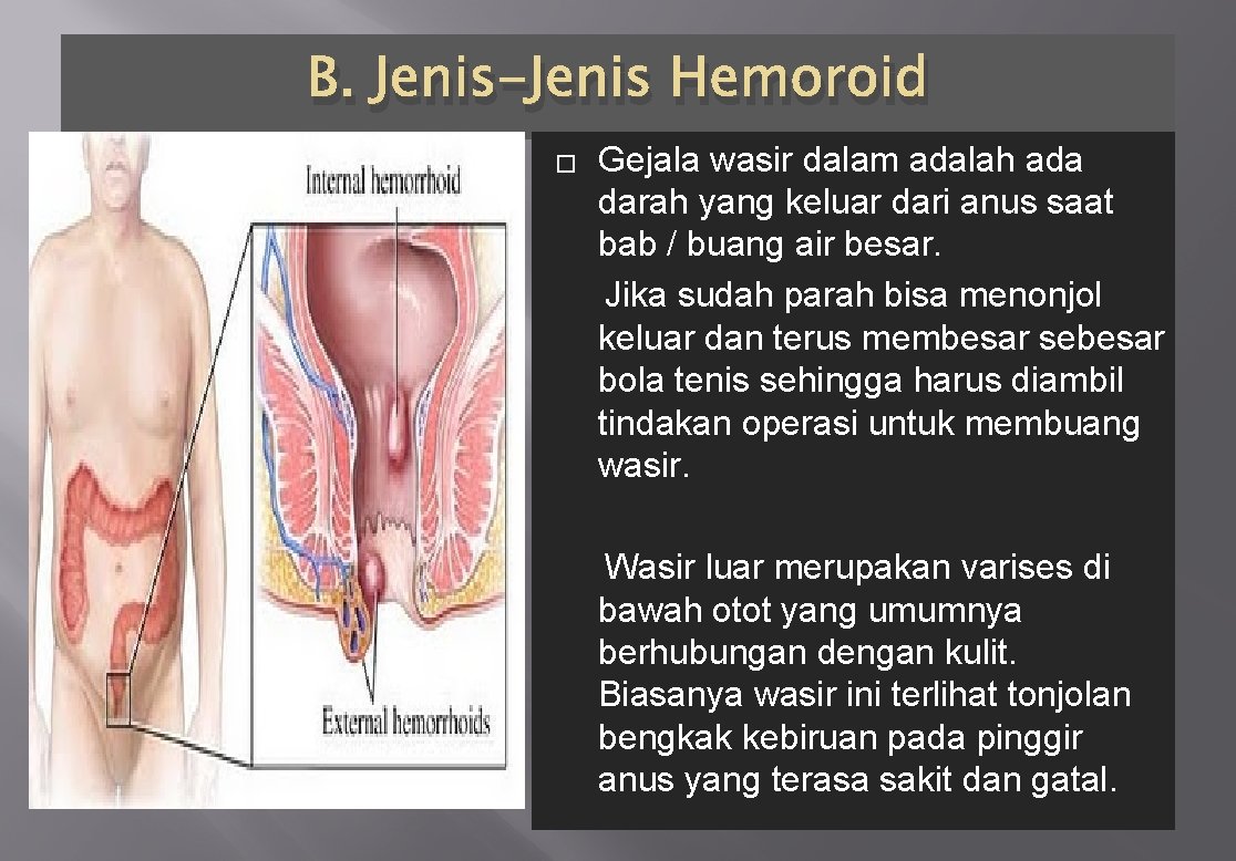 B. Jenis-Jenis Hemoroid Gejala wasir dalam adalah ada darah yang keluar dari anus saat