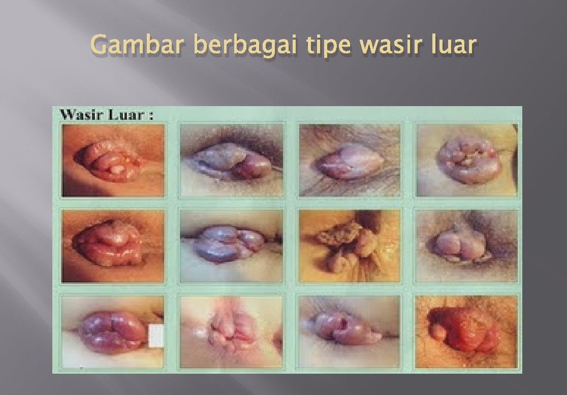 Gambar berbagai tipe wasir luar 