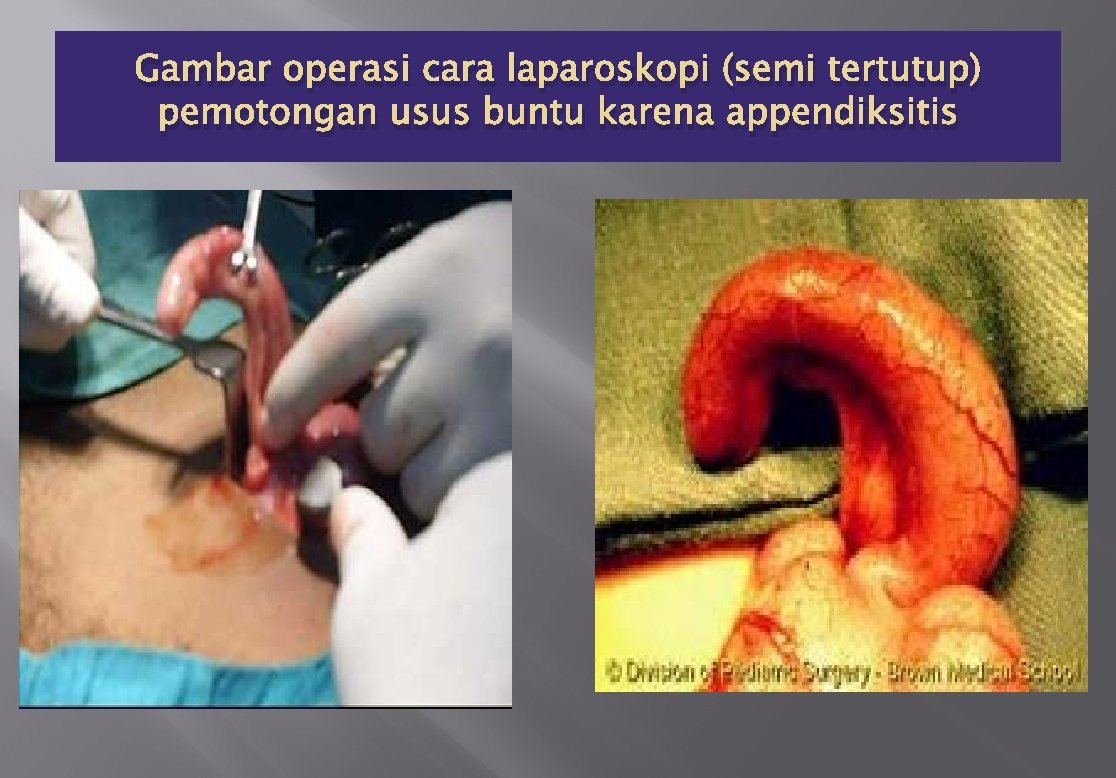 Gambar operasi cara laparoskopi (semi tertutup) pemotongan usus buntu karena appendiksitis 