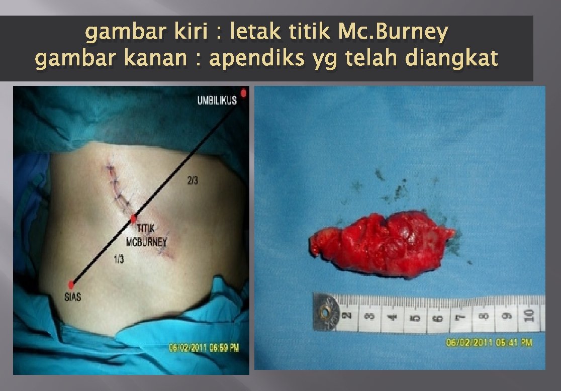 gambar kiri : letak titik Mc. Burney gambar kanan : apendiks yg telah diangkat