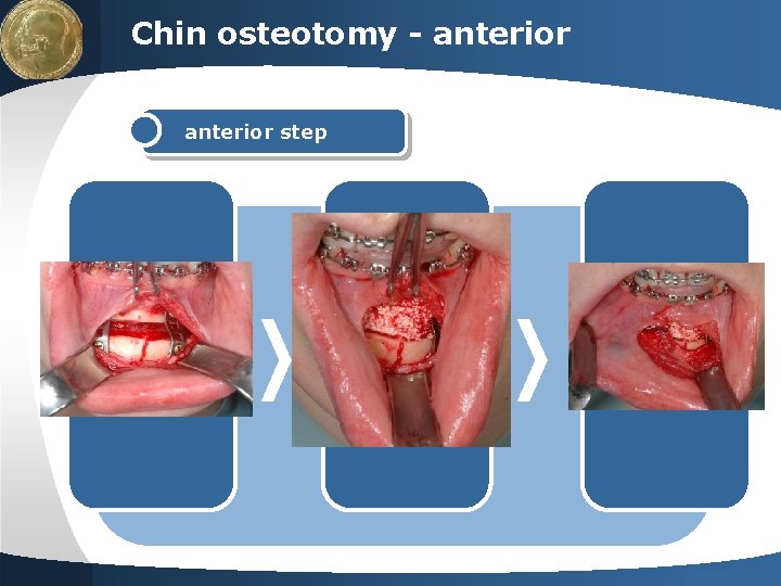 LOGO Chin osteotomy - anterior step text 2 Your site here LOGO Chin osteotomy - anterior step text 2 Your site here