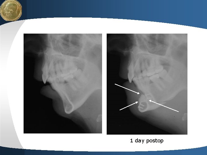 LOGO 1 day postop Your site here LOGO 1 day postop Your site here