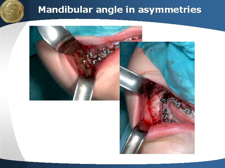 LOGO Mandibular angle in asymmetries Your site here 